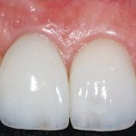Лечение передних зубов