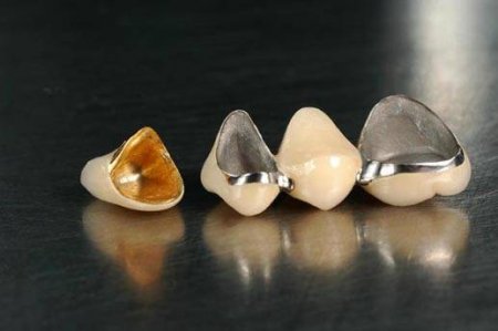 Металлокерамические зубные мосты