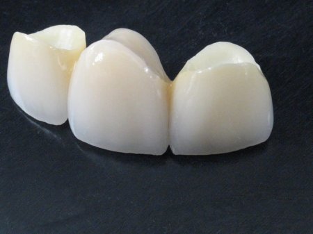 Мостовидные зубные протезы на основе оксида циркония