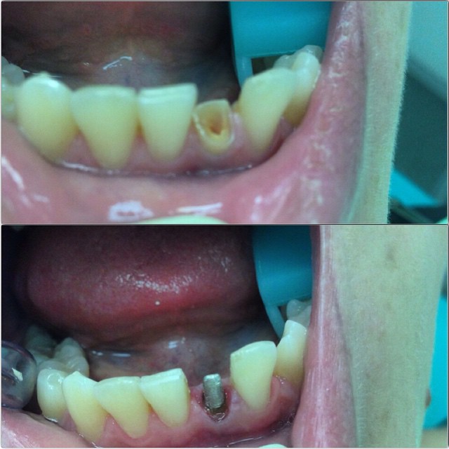 Восстановление корня 1 зуба