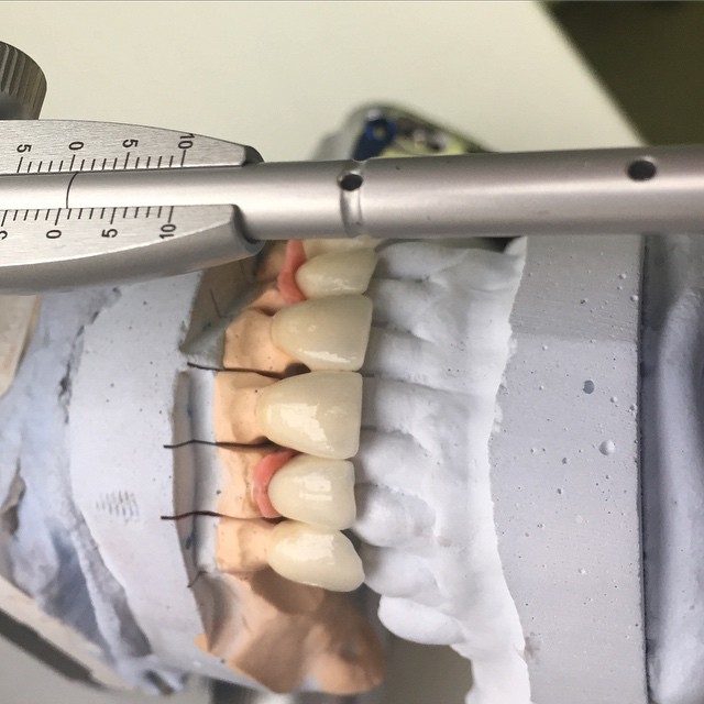Циркониевые зубные коронки после изготовления в зуботехнической лаборатории