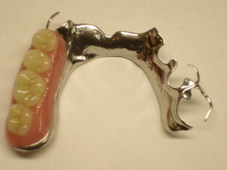 Бюгельное протезирование зубов: процедура и стоимость