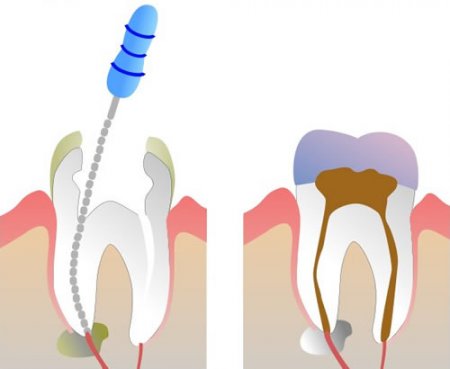 Депульпация – удаление зубного нерва