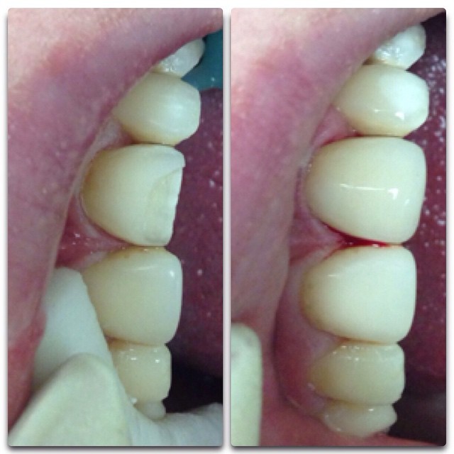 Реставрация переднего зуба до и после