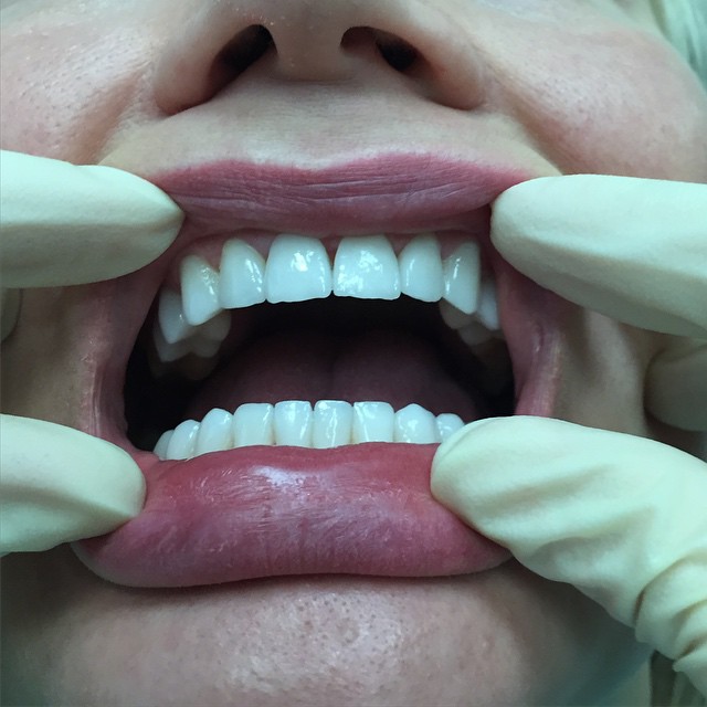 Зубы после установки виниров