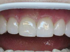 После реставрации переднего зуба